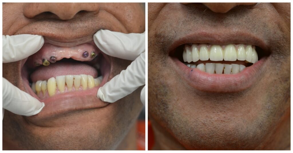 Full mouth dental implants before and after
